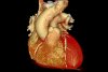 New Gene Editing Treatment Cuts Dangerous Cholesterol in Small Study