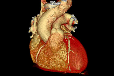 New Gene Editing Treatment Cuts Dangerous Cholesterol in Small Study