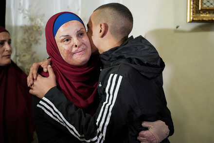 A disfigured woman whose case has become well known is among the Palestinians released.